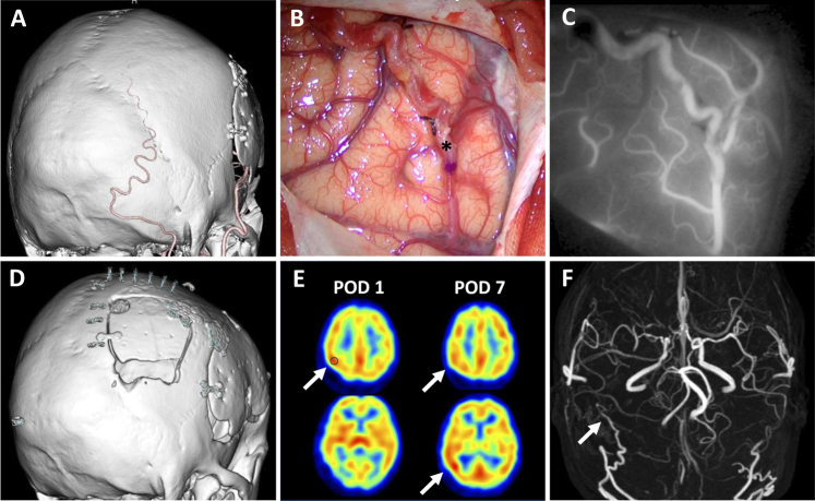 Symptomatic cerebral hyperperfusion after occipital artery-posterior cerebral artery bypass in a patient with moyamoya disease: illustrative case.