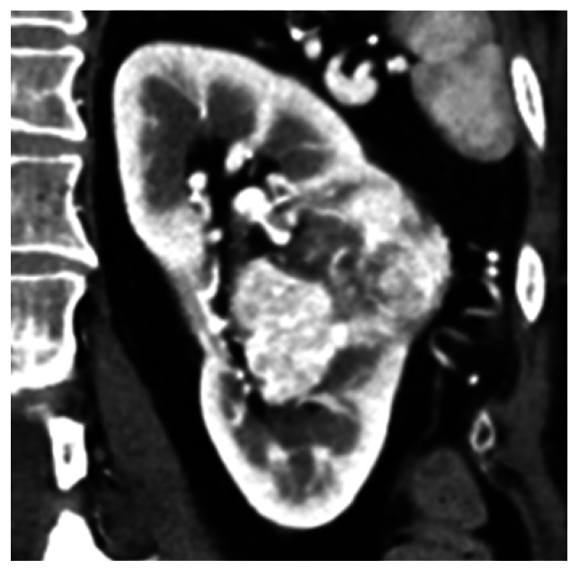 Accuracy of Contrast-enhanced CT in Diagnosing Small-sized cT3a Renal Cell Carcinoma and Analysis of Factors Predicting Downstaging to pT1.