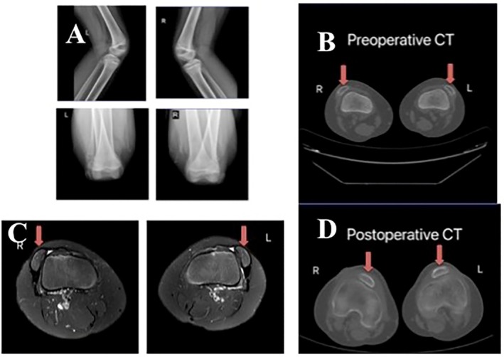 4in1 Procedure in Treating Congenital Dislocation of Patella in Children.