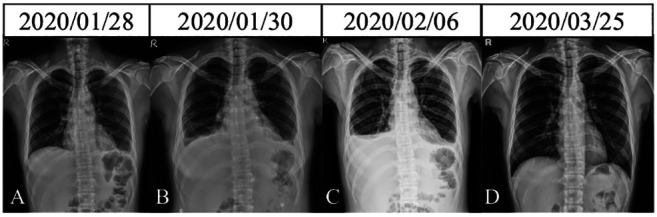 Immunomodulatory Effects of Molecular Hydrogen Therapy in Systemic Lupus Erythematosus With Pericarditis and Pleuritis: A Case Report.