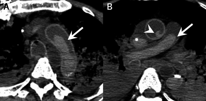 Postmortem computed tomography assessment of intracardiac and intravascular blood clots and gravitational sedimentation: clinical and laboratory associations in 114 in-hospital deaths.