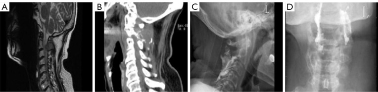 Rare case of recurrent refractory multiple myeloma with lipid deposition in the vertebral body: a case description.