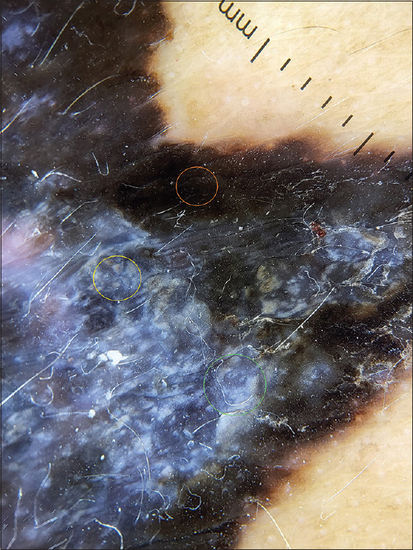 Nodular Melanoma.