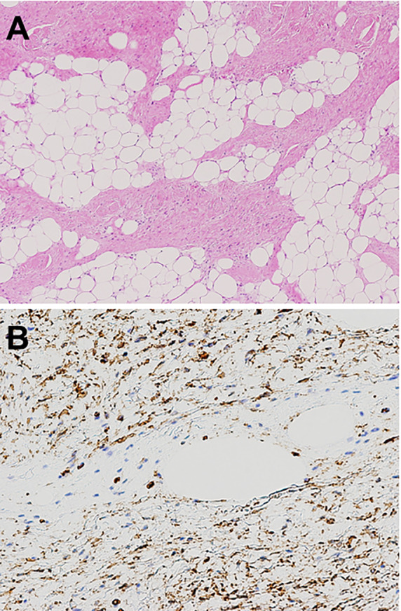 Lipofibromatosis Revisited.