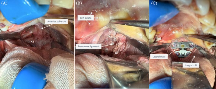 Design of a Novel Artificial Atlanto-Odontoid Joint and Its Anatomical and Radiological Studies Following Transoral Pharyngeal Approach Arthroplasty.