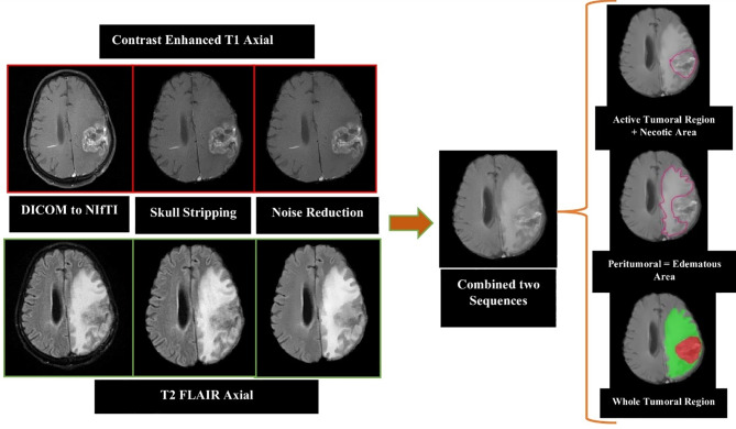 Evaluating machine learning models for post-surgery treatment response assessment in glioblastoma multiforme: a comparative study of gray level co-occurrence matrix (GLCM), curvelet, and combined radiomics features selected by multiple algorithms.