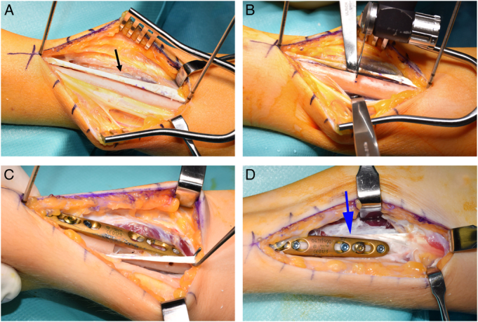 A New Technique of Brachioradialis Tendon Rerouting Combined With Osteotomy in Contractures of the Forearm.