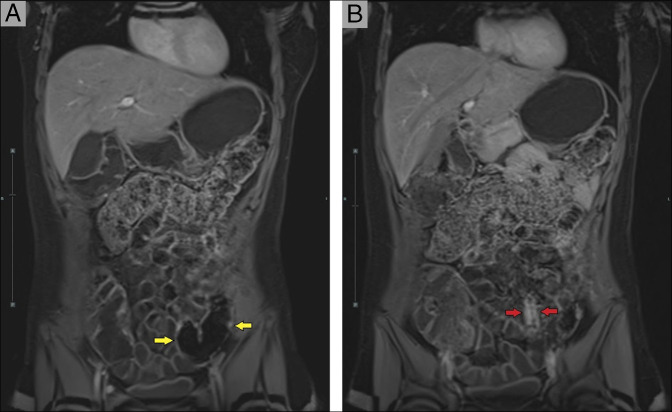 A Therapeutic Tightrope: Managing Coexisting Crohn Disease and Systemic Lupus Erythematosus With Risankizumab.