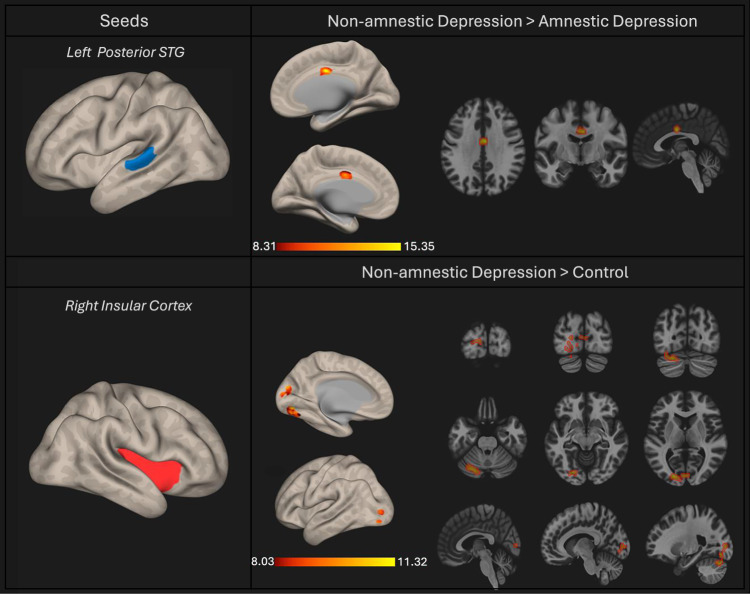 Subjective cognitive decline in major depressive patients is associated with altered entropy and connectivity changes of temporal and insular region.