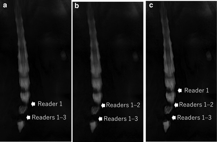 Super-resolution deep learning reconstruction to evaluate lumbar spinal stenosis status on magnetic resonance myelography.