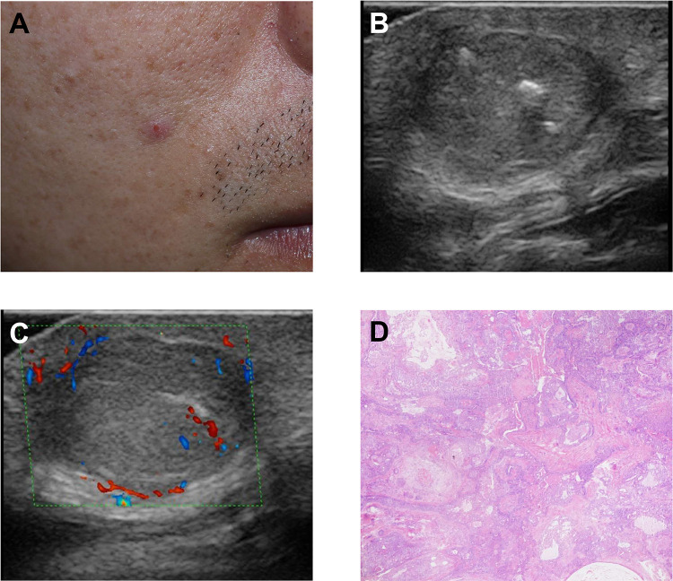Very-High-Frequency Ultrasonographic Profiling Characteristics of Nodular Hidradenoma: A Retrospective Analysis.