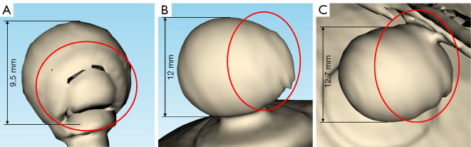 Novel RANSAC-based method for detecting and estimating externally attached marker spheres in craniomaxillofacial CT images.