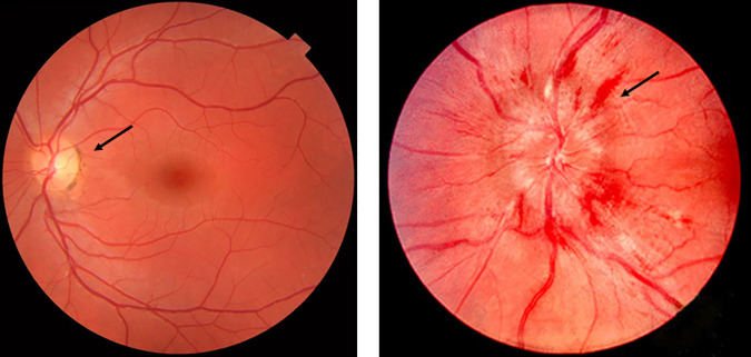 Detecting papilloedema as a marker of raised intracranial pressure using artificial intelligence: A systematic review.