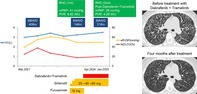 BRAF V600E-Mutant Diffuse Pulmonary Langerhans Cell Histiocytosis Successfully Treated With Dabrafenib Plus Trametinib: A Case Report.