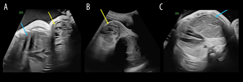 Ex-Utero Intrapartum Treatment for a Fetal Cervical Teratoma with Mediastinal Extension: A Case Report.