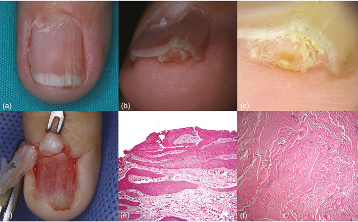 Onychopapilloma and Ungual Fibroma Revealing Late-Diagnosed Tuberous Sclerosis