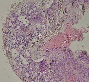 Intraosseous Hemangioma of the Zygomatic Bone: A Rare Maxillofacial Case in a 57-Year-Old Woman.