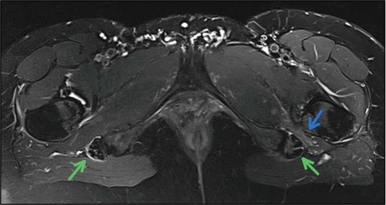 Exploring non-invasive diagnostic tools for deep gluteal syndrome: a multimodal approach integrating clinical and imaging techniques.