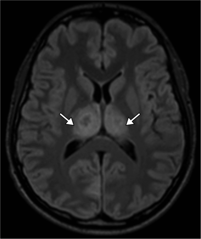 Acute necrotizing encephalopathy in a young adult triggered by adenovirus: a rare etiology of a devastating neurological syndrome.