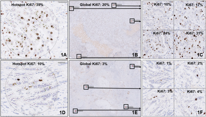 Global scoring method of Ki67 immunohistochemistry in breast cancer demonstrates improved concordance using real-world multi-institutional data.