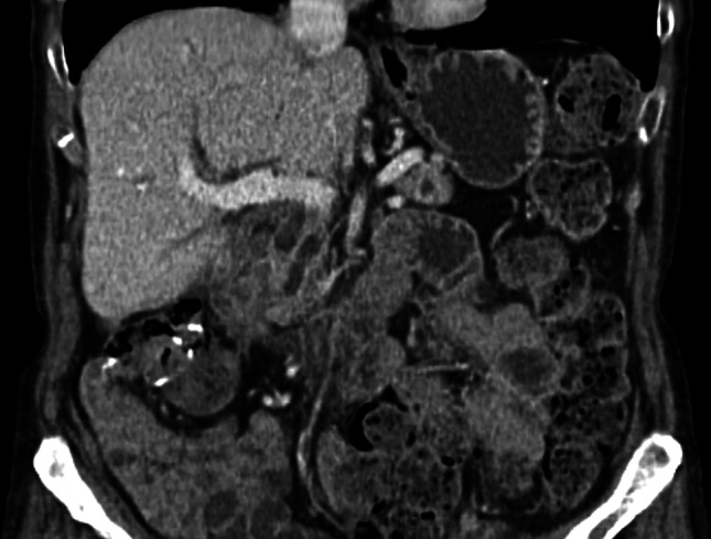 Double Endoscopic Bypass: A Durable Solution to Pair With Improving Systemic Therapy for Metastatic Cancer.