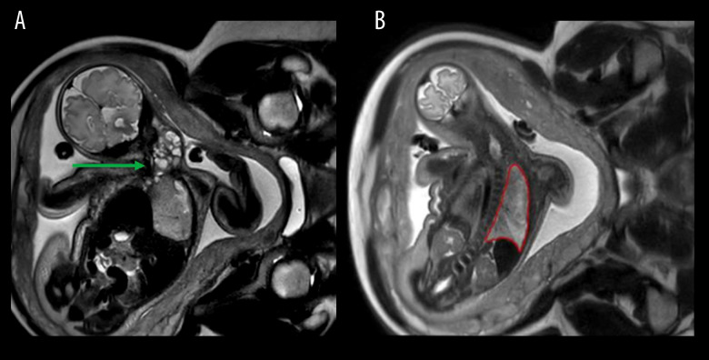 Ex-Utero Intrapartum Treatment for a Fetal Cervical Teratoma with Mediastinal Extension: A Case Report.