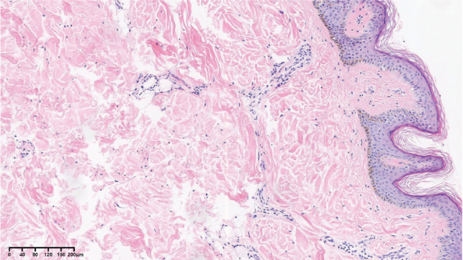 Giant Plaques on the Back with Gyrus-like Alteration: A Quiz.