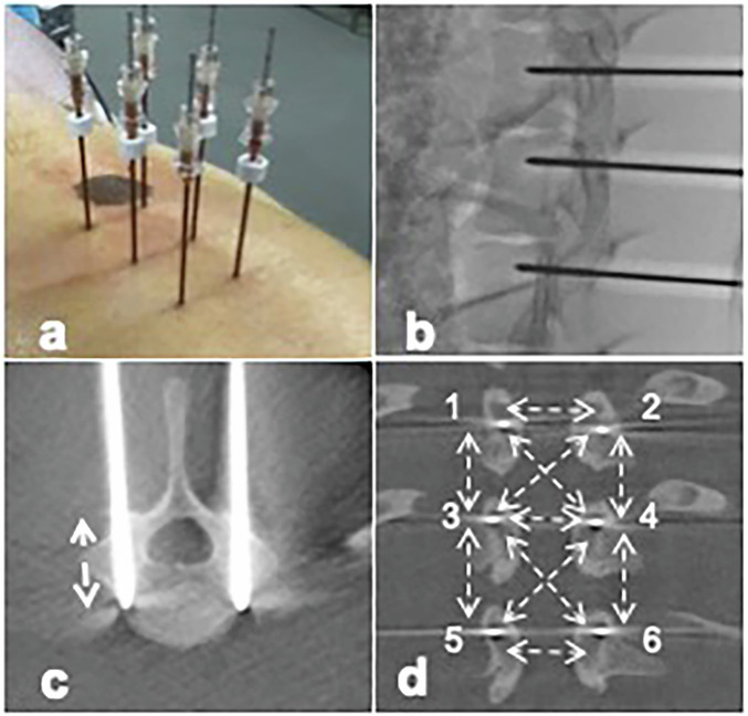 Electrochemotherapy of spinal metastasis using transpedicular approach: a preclinical safety animal study.
