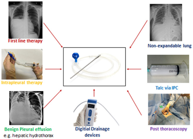The Evolution of the Indwelling Pleural Catheter.