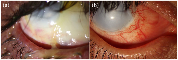 Topical erythropoietin in the management of scleral necrosis: a narrative review.