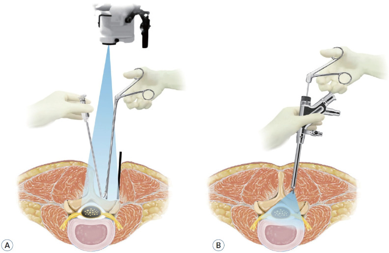 Full-Endoscopic Spine Surgery : Its Roles and Limitations.