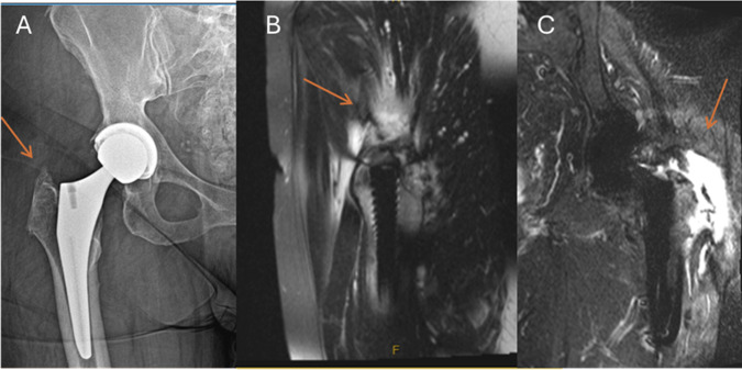 Soft-Tissue Sources of Extra-articular Pain Following Total Hip Arthroplasty: A Comprehensive Review.
