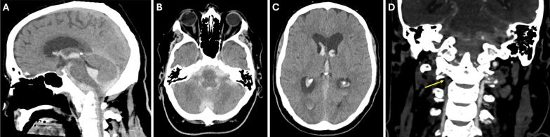 CPPD-related basilar impression with vertebral artery dissection and subsequent subarachnoid hemorrhage: illustrative case.