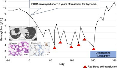 Pure Red Cell Aplasia That Developed 13 Years After Thymoma Treatment: A Case Report and Literature Review.