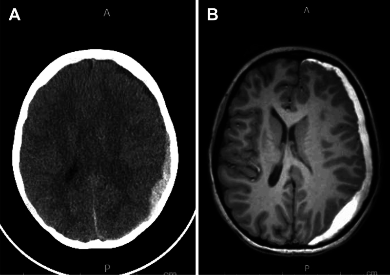 Epidural blood patch for cerebrospinal fluid leak-induced subdural hematoma in a pediatric patient: illustrative case.