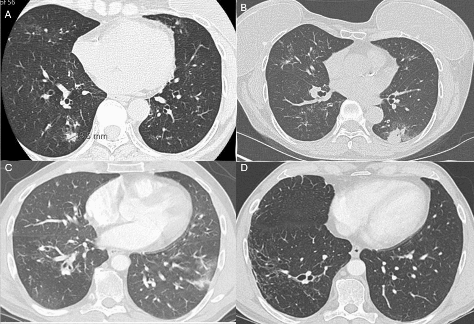 Duo biologic therapy using mepolizumab and omalizumab in refractory ABPA: two cases.