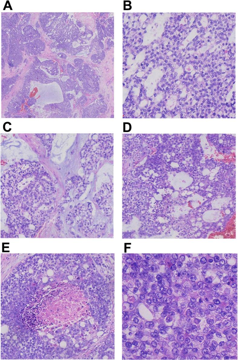 SMARCB1 (INI1)-deficient sinonasal carcinoma with yolk sac differentiation, a case of long-term clinical remission after multiple rounds of radiotherapy-a case report and literature review.