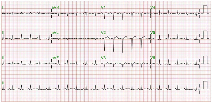 Immunomodulatory Effects of Molecular Hydrogen Therapy in Systemic Lupus Erythematosus With Pericarditis and Pleuritis: A Case Report.
