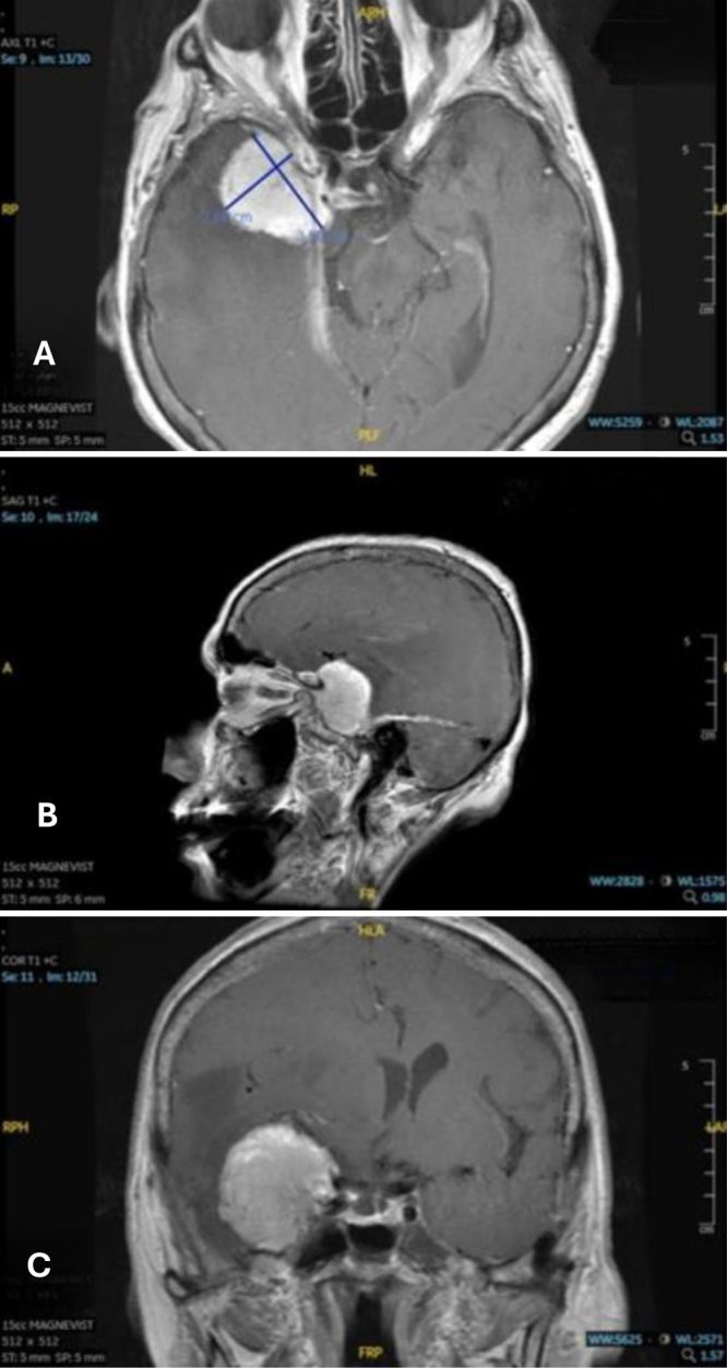 Brain tumors linked to Chernobyl radiation exposure: a case study and historical perspective. Illustrative cases.