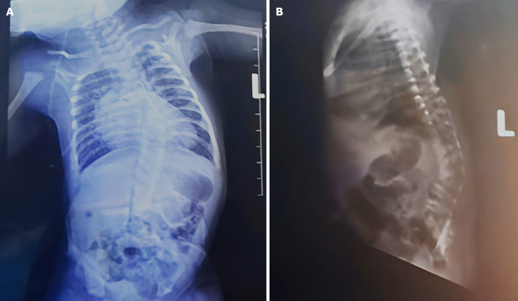 Congenital scoliosis with truncus arteriosus type 1 in a preterm neonate: A case report.