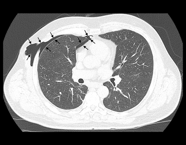 Postoperative Residual Pleural Space: A Risk Factor for Chest Wall Hernia After Thoracoscopic Surgery.