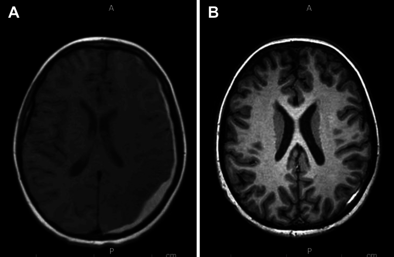 Epidural blood patch for cerebrospinal fluid leak-induced subdural hematoma in a pediatric patient: illustrative case.