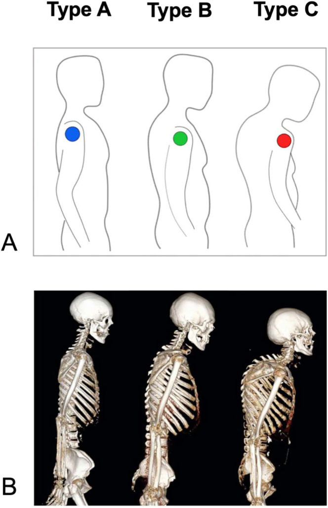 The scapulothoracic conundrum in reverse shoulder arthroplasty: where do we stand and what is yet to expand?