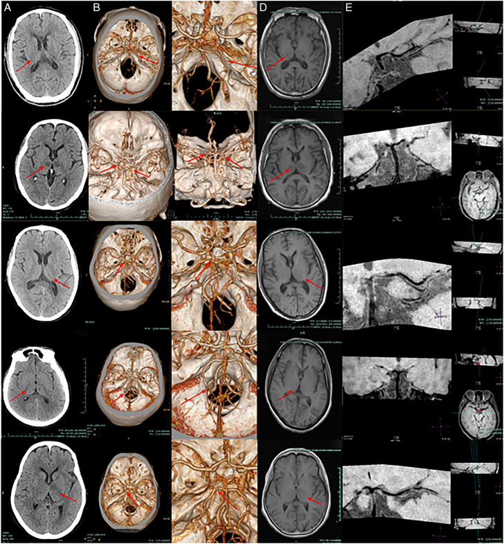 Clinical and Imaging Characteristics of Thalamic Infarction Combined With Moderate-to-Severe Stenosis of the Posterior Cerebral Artery: A Single-Center Experience.