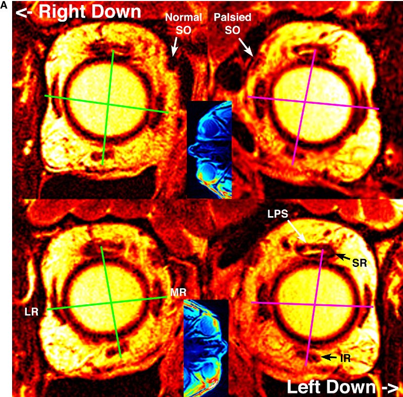 Functional Anatomy of Ocular Counter-Rolling in Superior Oblique Palsy.