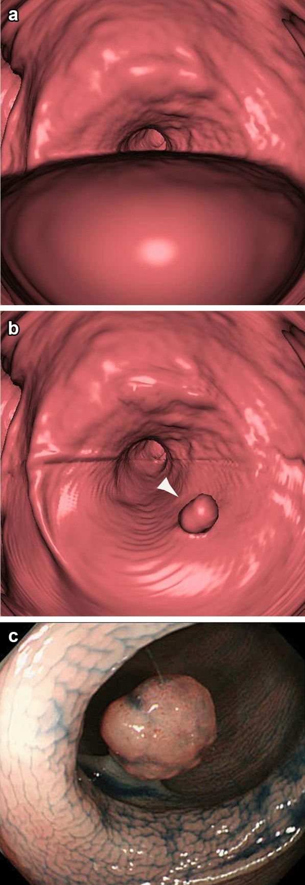 The potential of CT colonography for colorectal cancer screening in Japan.