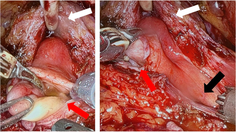 Combined robot-assisted surgery of upper and lower genitourinary tract with excellent early functional and oncological outcome - a case report of a concomitant nerve-sparing radical prostatectomy, diverticulectomy and ureterectomy.
