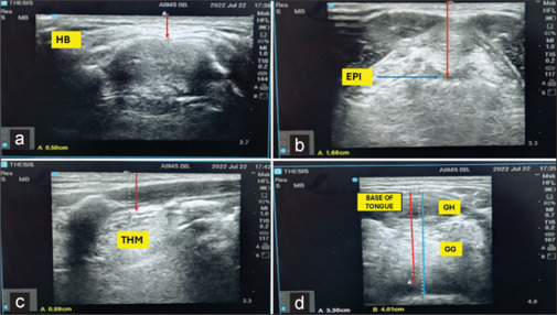 Evaluation of the predictive value of tongue height to oral cavity height ratio and anterior neck soft tissue measurements for difficult laryngoscopy in patients with unanticipated difficult airway: A prospective observational study.