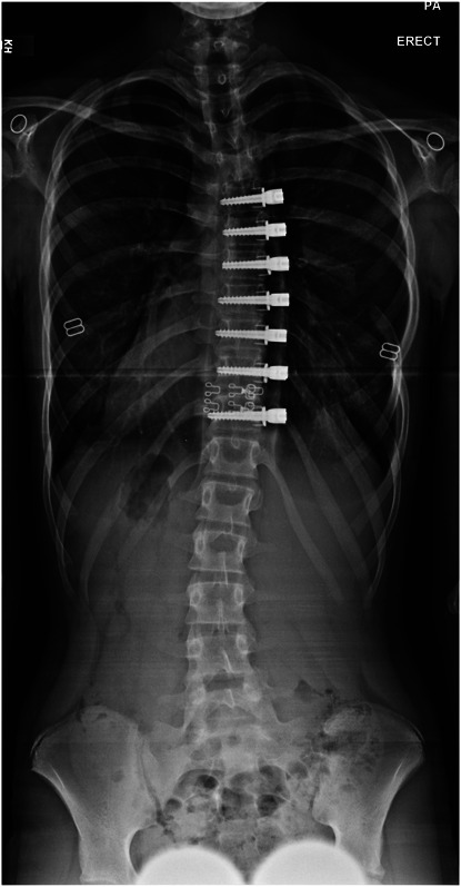 Results of a Retrospective FDA Investigational Device Exemption Study for Anterior Vertebral Body Tethering in Adolescent Idiopathic Scoliosis with 3-Year to 10-Year Follow-Up.