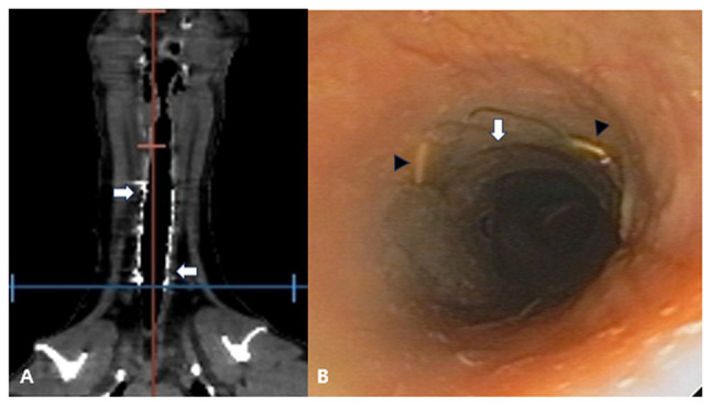 Tracheal Reconstruction Using a Nitinol Stent for Thoracic Tracheal Rupture.